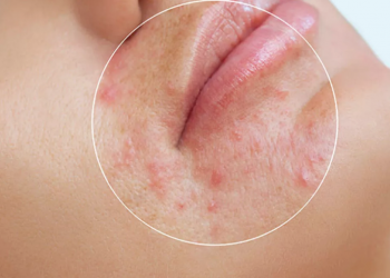 Duş yaparken yüzünüzü sıcak sudan uzak tutmanız için 5 sebep…