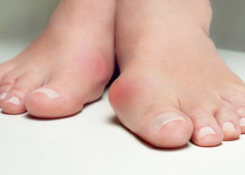 Ayaklarınızın taraklı olduğunu nasıl anlarsınız? Taraklı ayak nedir ve taraklı ayak nasıl tedavi edilir? Halluks Valgus nasıl incelir?