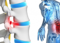 Bel fıtığının belirtileri nelerdir? Bel fıtığı nasıl önlenir? Bel fıtığı nedir ve neden olur?