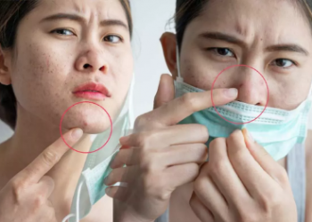 Maskne nedir ve neden olur? Maskne ile nasıl başa çıkılır? Maskeler Sivilce Yapar mı?