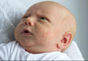 İsilik Nedir? Bebeğinizde İsilik Tedavisi Nasıl Yapılır?