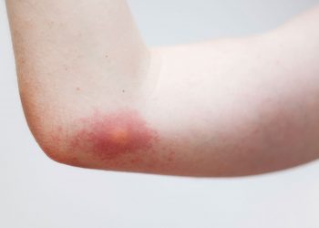 Böcek Isırığı Kalp Krizine Neden Olabilir…